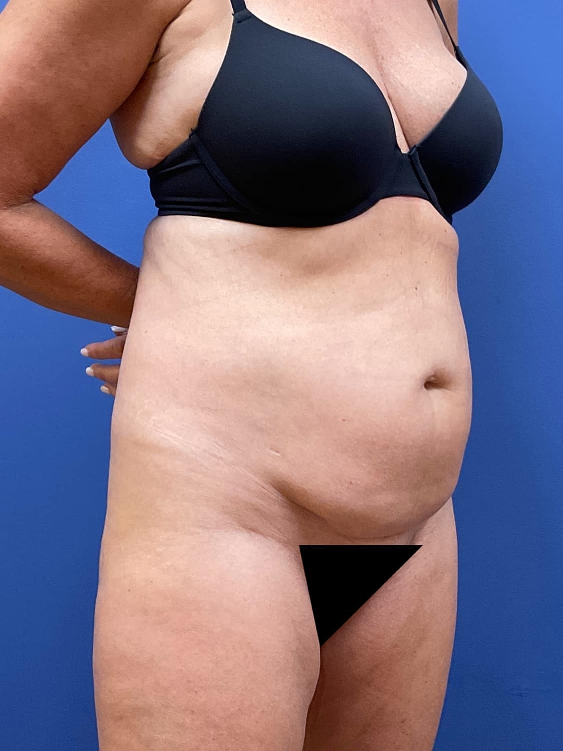 Tummy Tuck Before & After