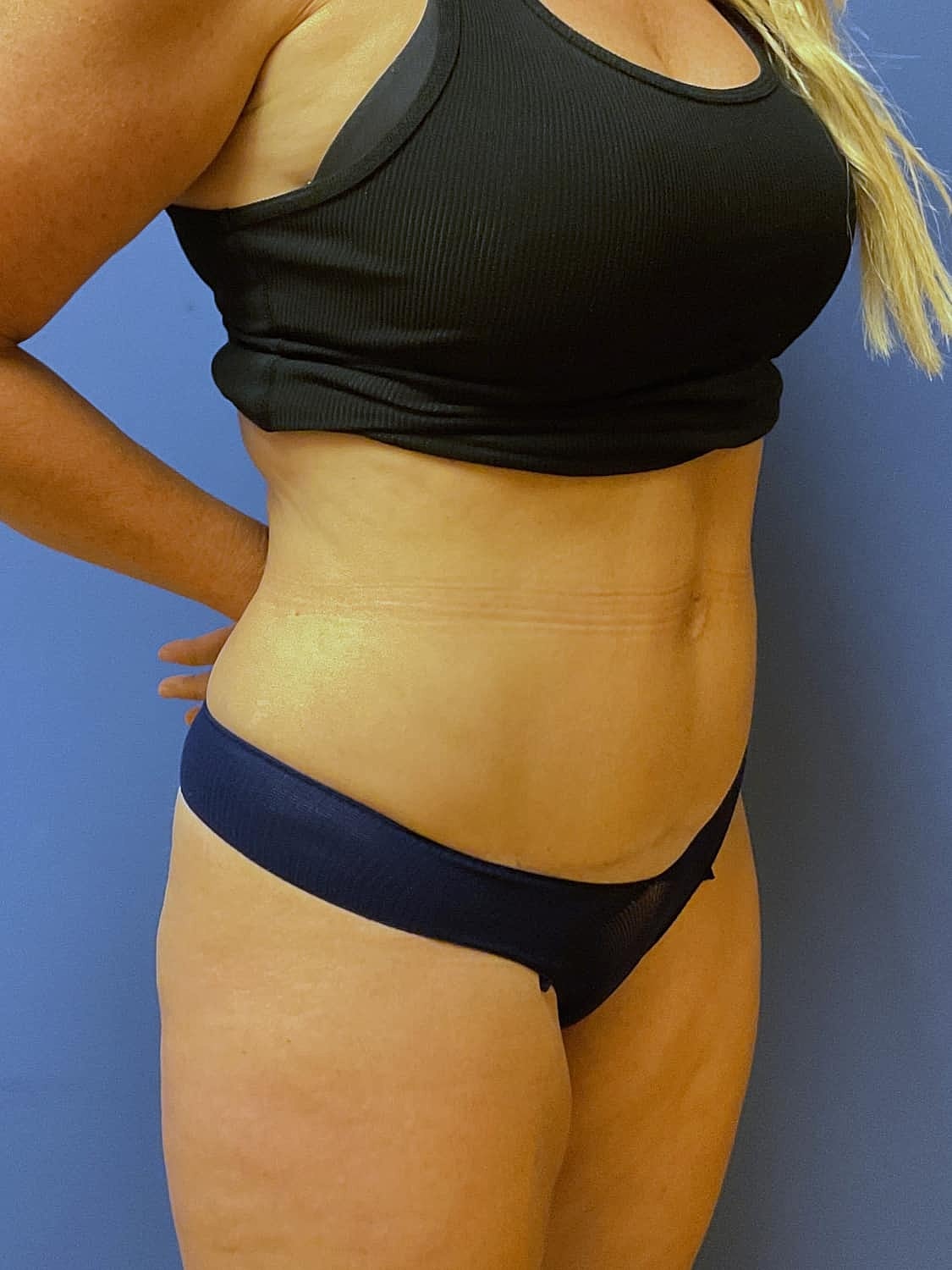 Tummy Tuck Before & After