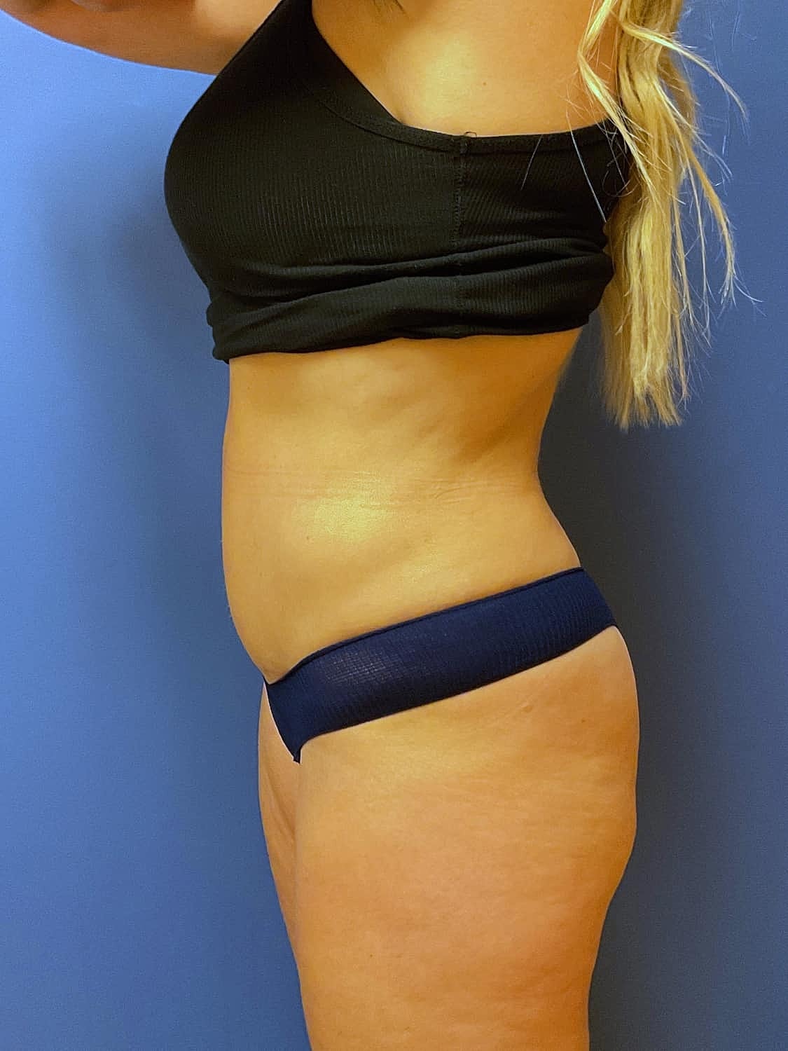 Tummy Tuck Before & After
