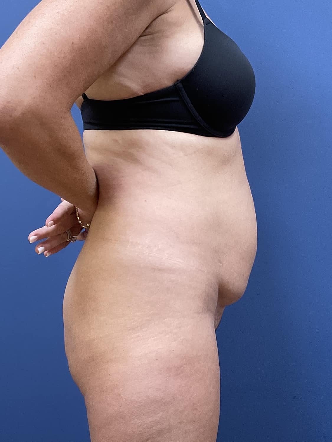 Tummy Tuck Before & After