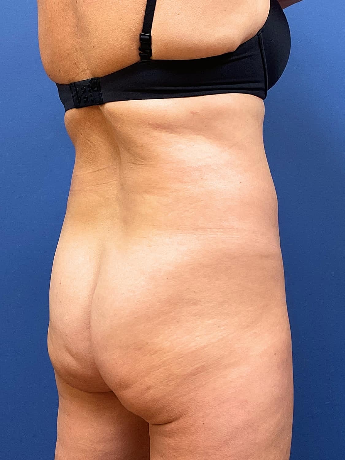 Tummy Tuck Before & After