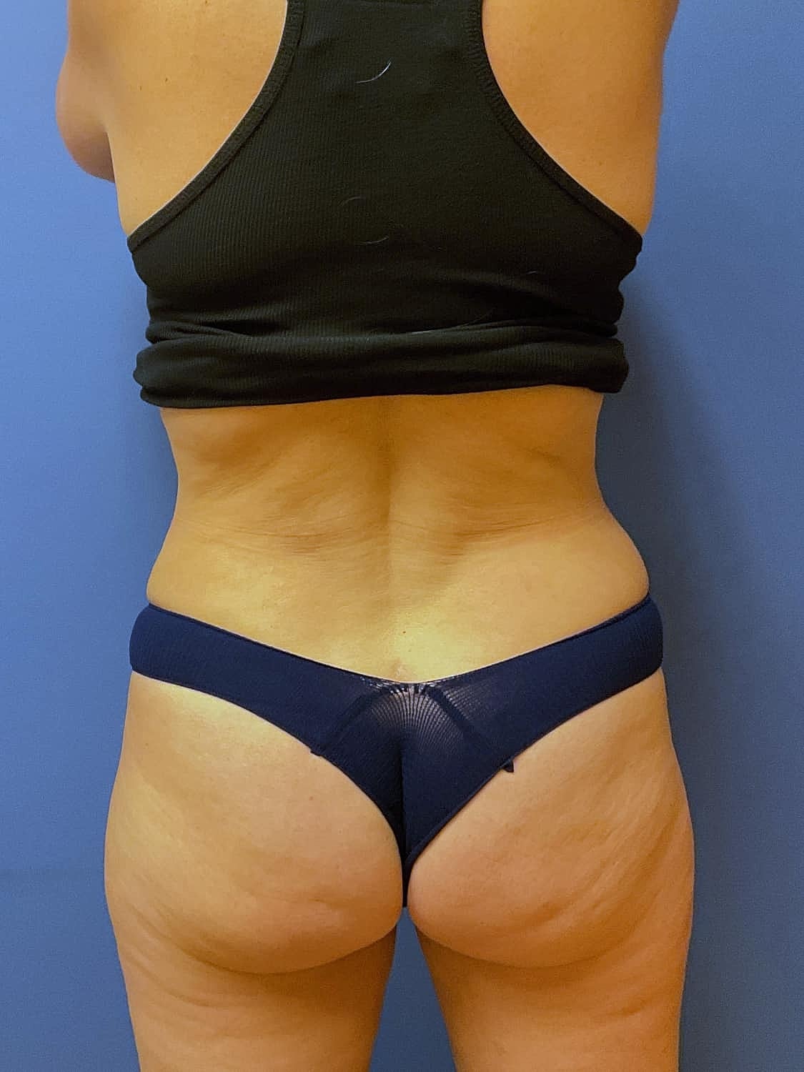 Tummy Tuck Before & After