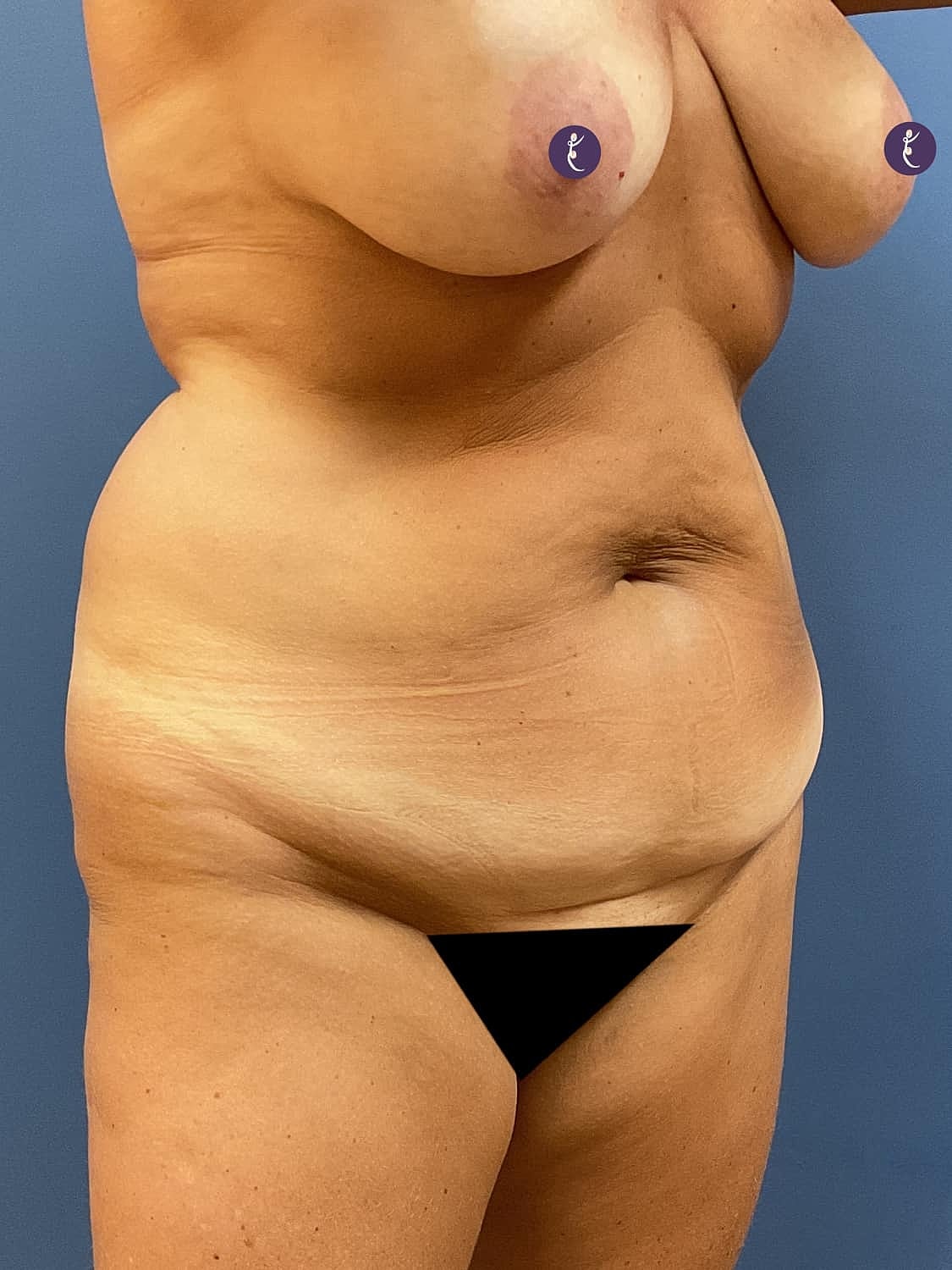 Tummy Tuck Before & After