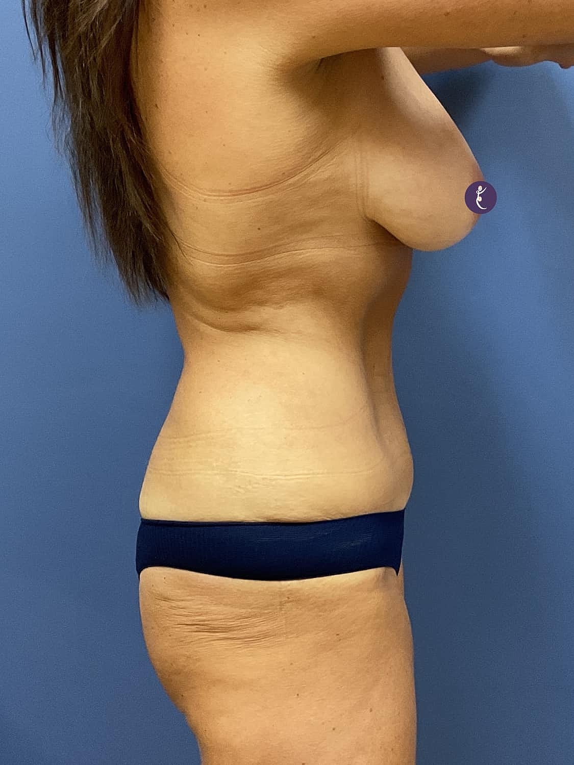 Tummy Tuck Before & After