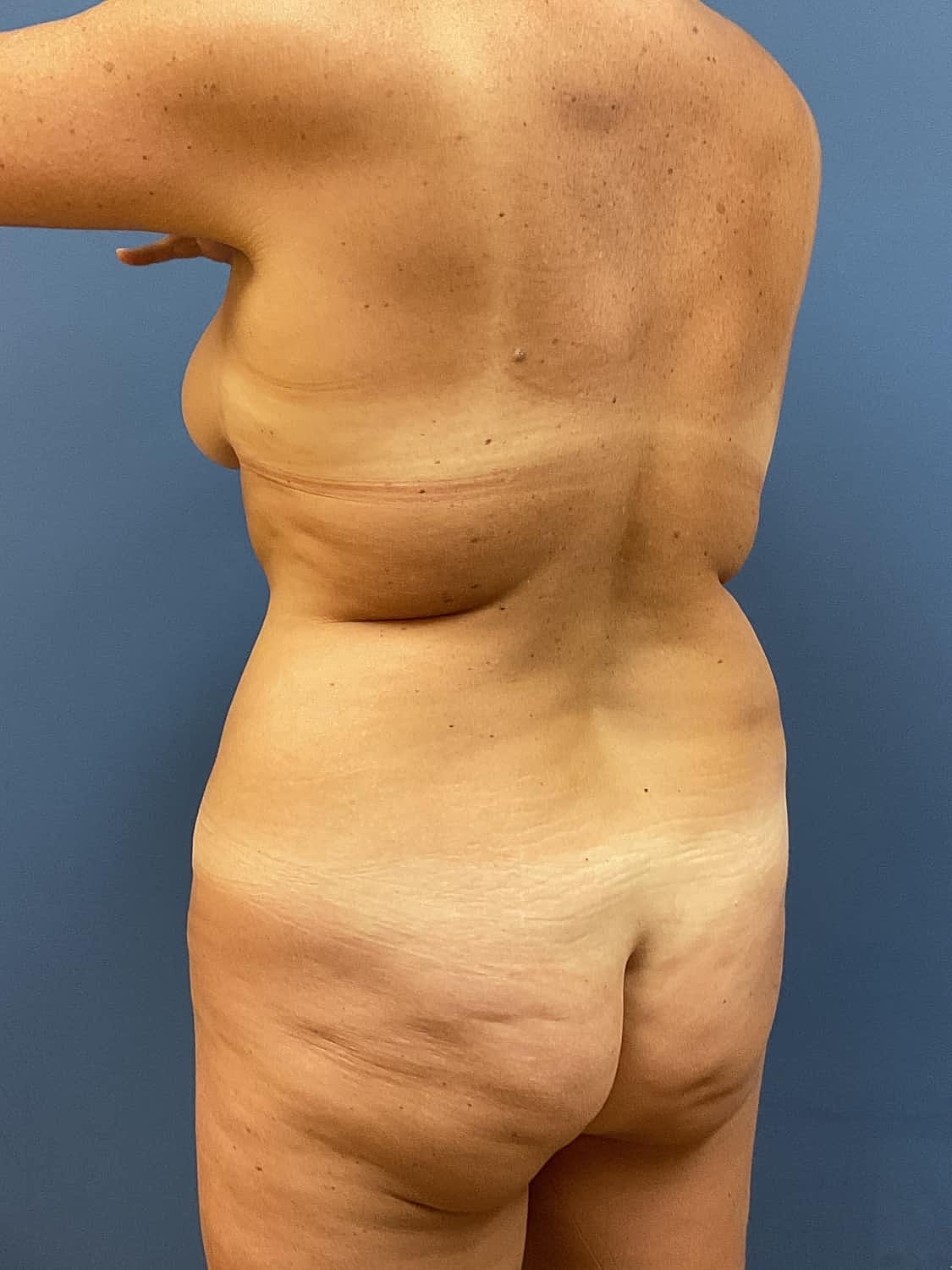 Tummy Tuck Before & After