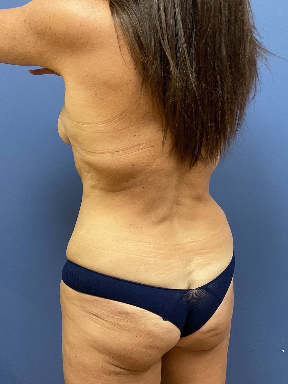 Tummy Tuck Before & After