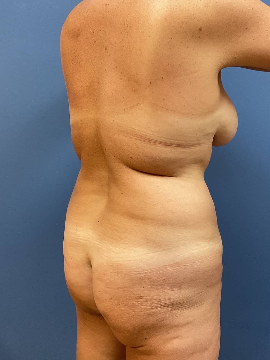 Tummy Tuck Before & After