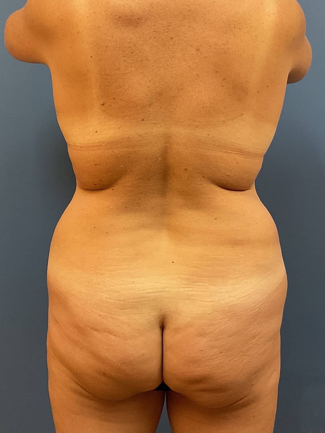 Tummy Tuck Before & After