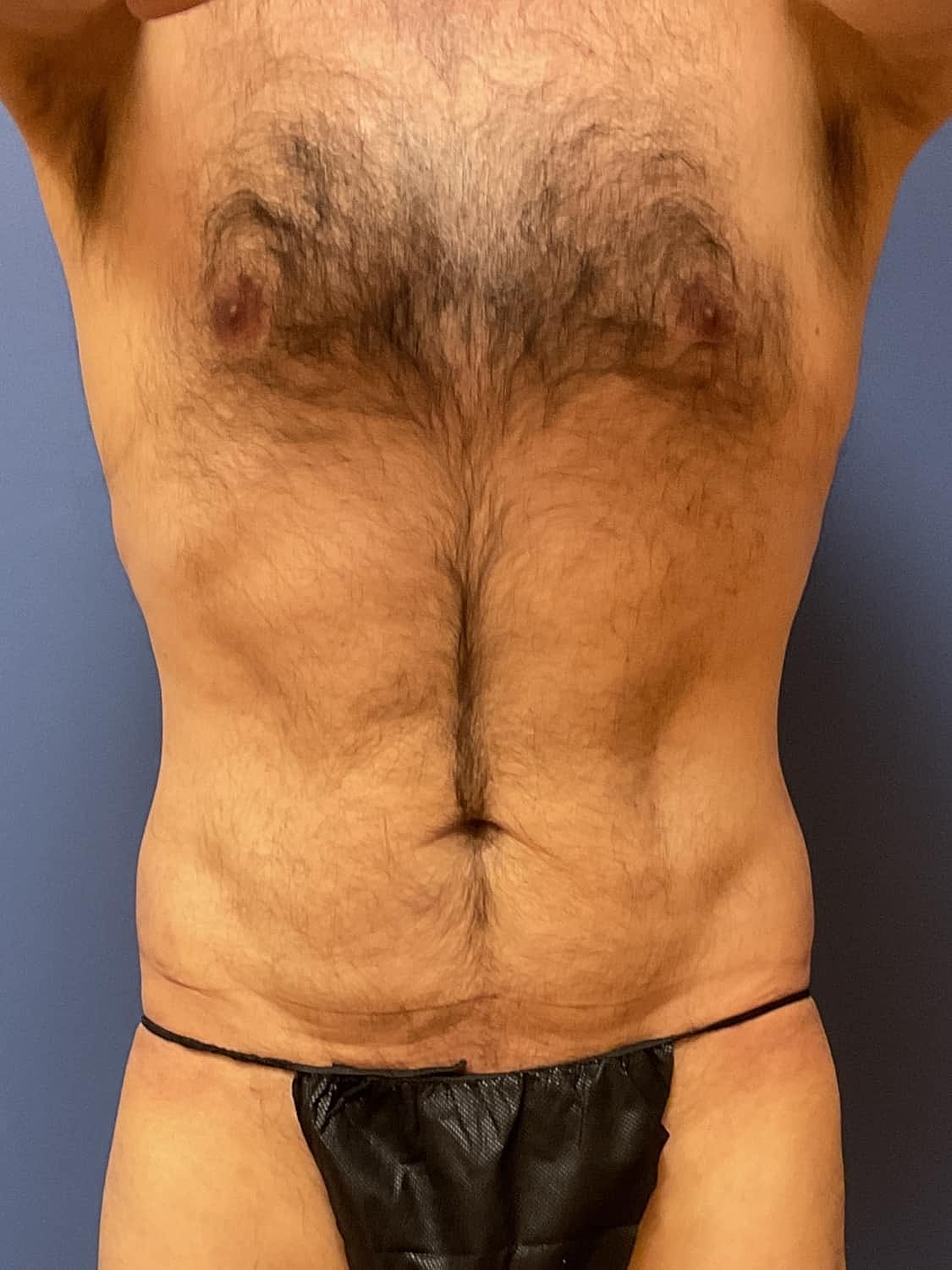 Tummy Tuck Before & After