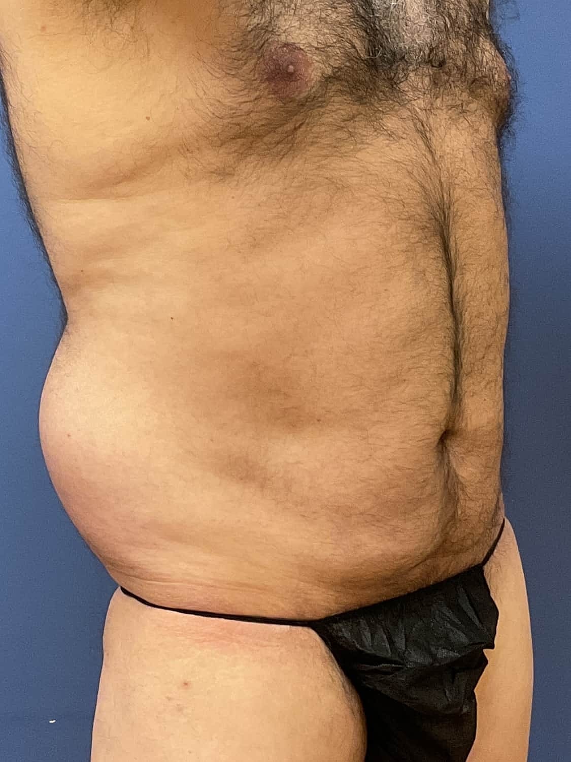 Tummy Tuck Before & After