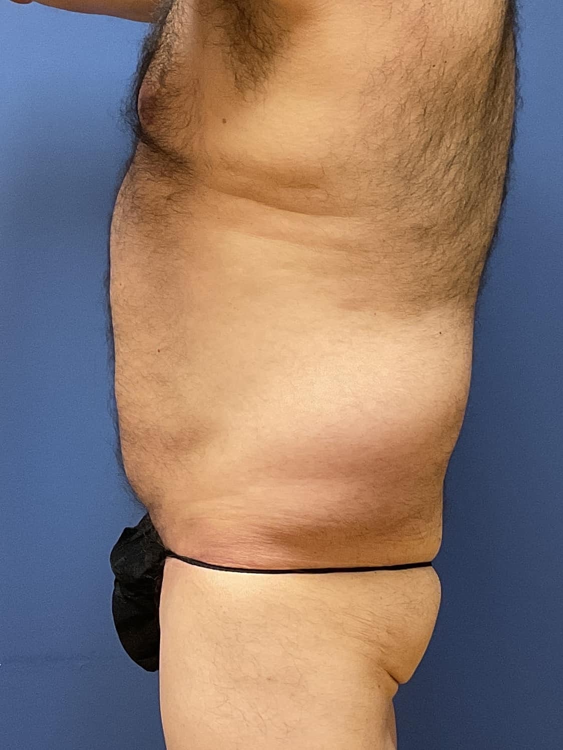 Tummy Tuck Before & After