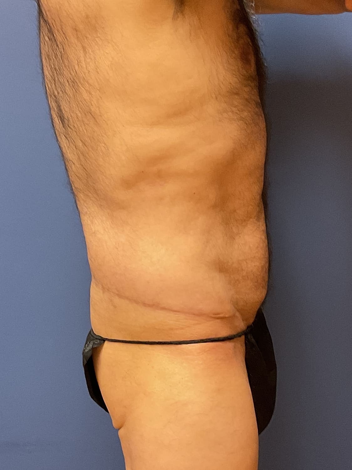 Tummy Tuck Before & After