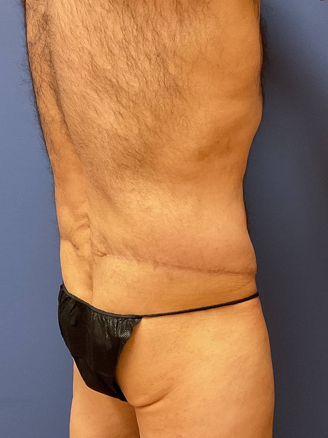 Tummy Tuck Before & After