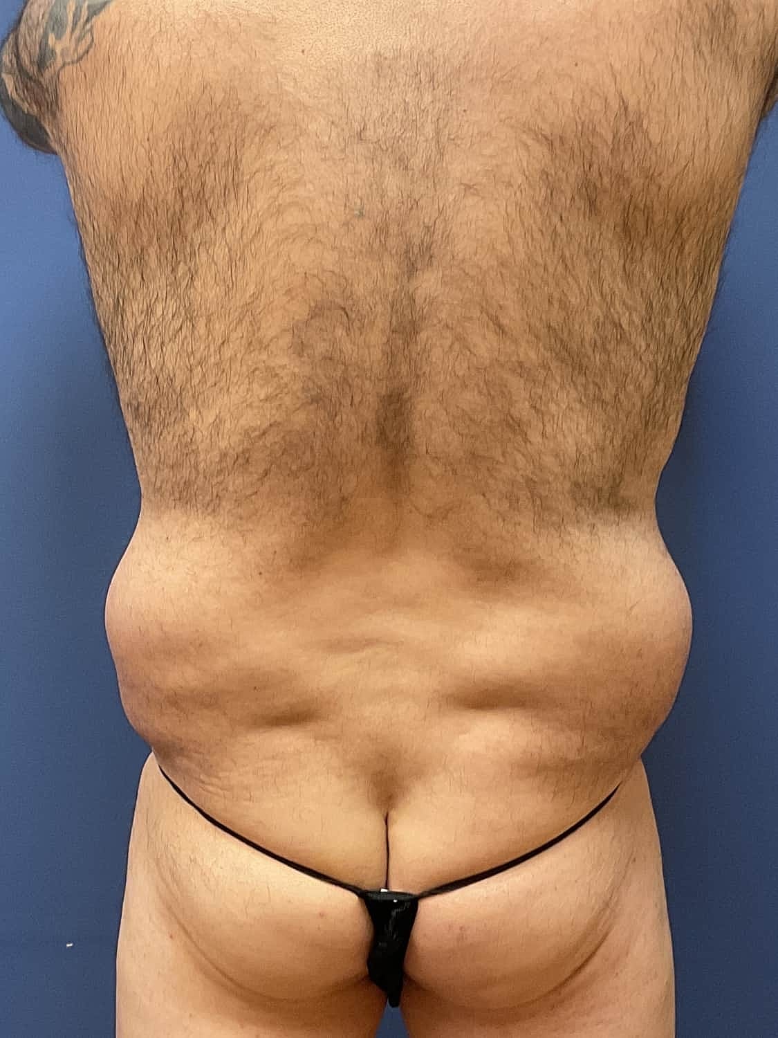 Tummy Tuck Before & After