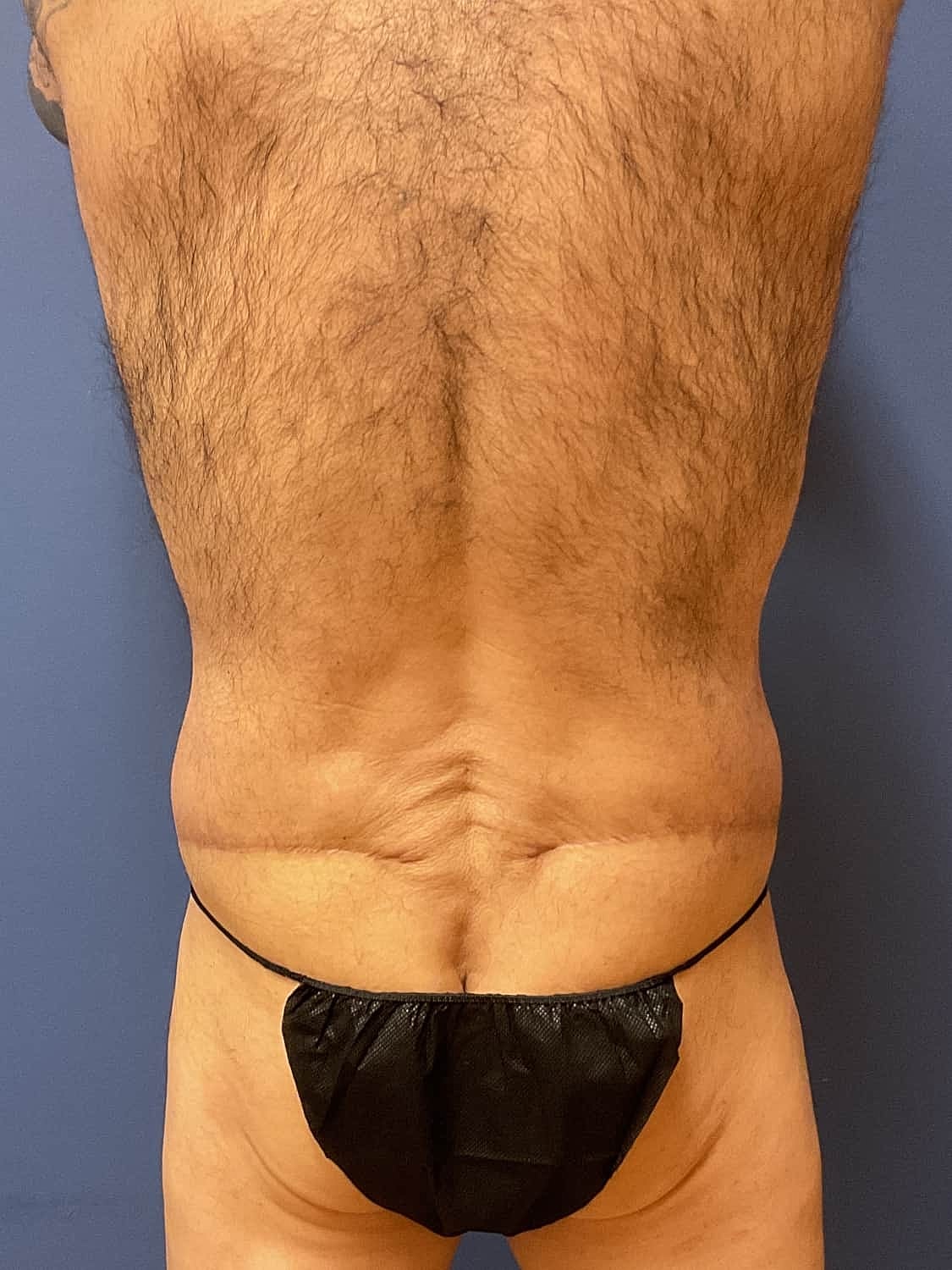 Tummy Tuck Before & After