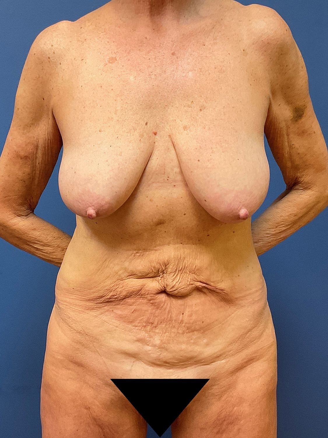 Tummy Tuck Before & After