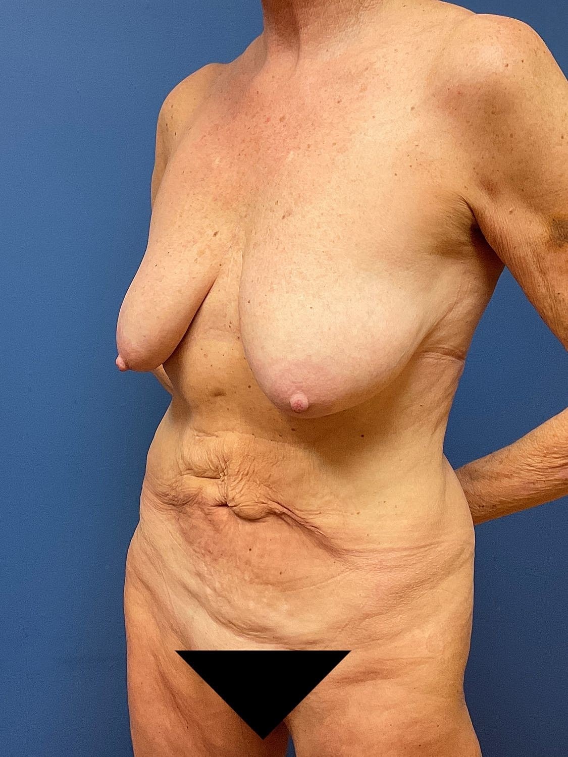 Tummy Tuck Before & After