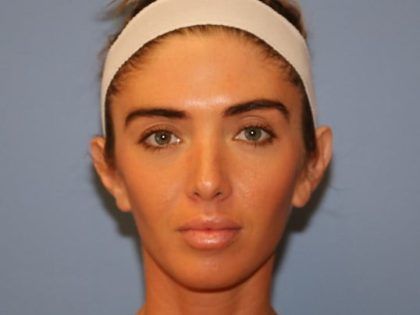 Ear Surgery Before & After