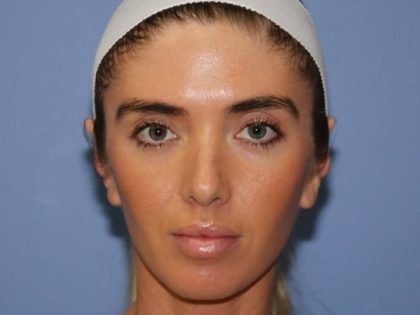 Ear Surgery Before & After