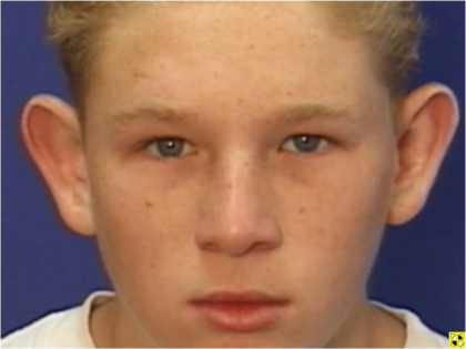 Ear Surgery Before & After