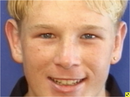 Ear Surgery Before & After