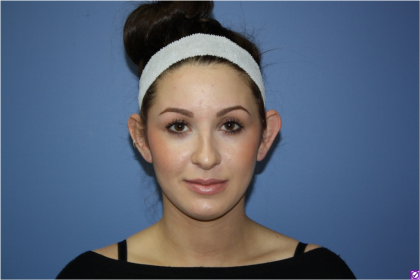 Ear Surgery Before & After