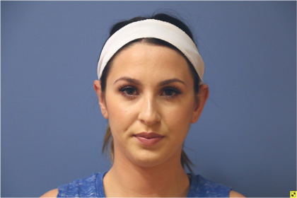 Ear Surgery Before & After