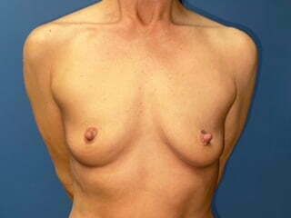 Breast Augmentation Before & After