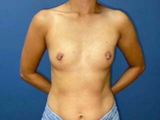 Breast Augmentation Before & After