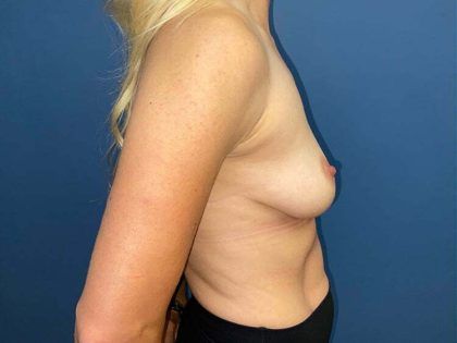 Breast Augmentation Before & After