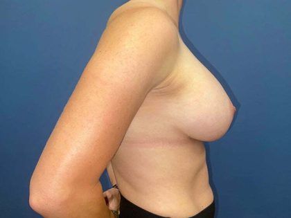 Breast Augmentation Before & After