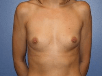 Breast Augmentation Before & After