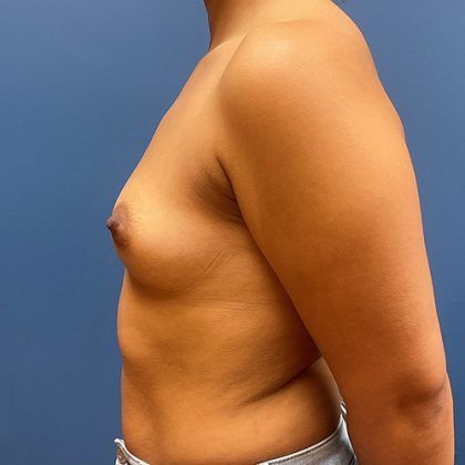 Breast Augmentation Before & After