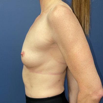 Breast Augmentation Before & After