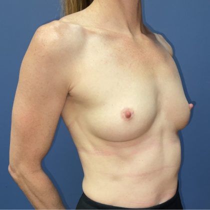 Breast Augmentation Before & After