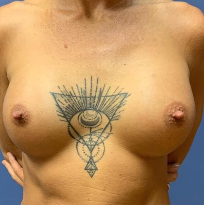 Breast Augmentation Before & After
