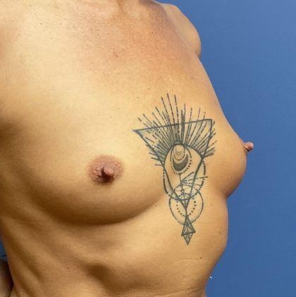 Breast Augmentation Before & After