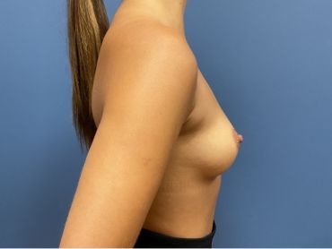 Breast Augmentation Before & After