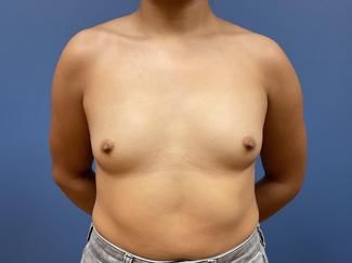 Breast Augmentation Before & After