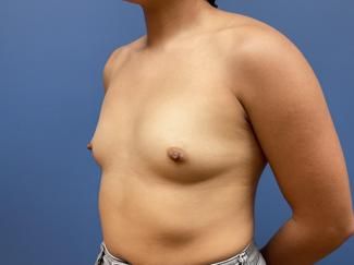 Breast Augmentation Before & After