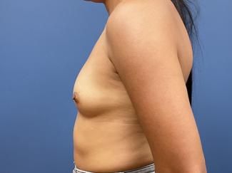 Breast Augmentation Before & After