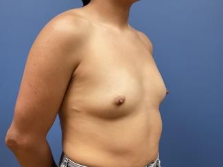 Breast Augmentation Before & After