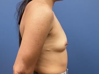 Breast Augmentation Before & After