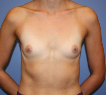 Breast Augmentation Before & After