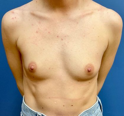 Breast Augmentation Before & After