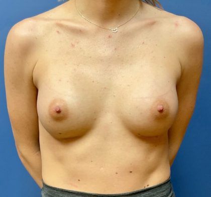 Breast Augmentation Before & After