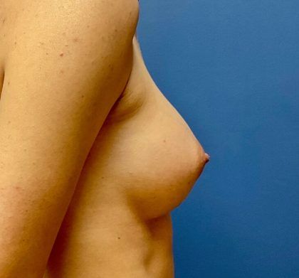 Breast Augmentation Before & After