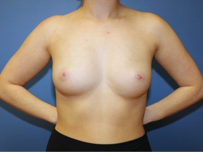Breast Augmentation Before & After