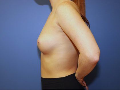 Breast Augmentation Before & After