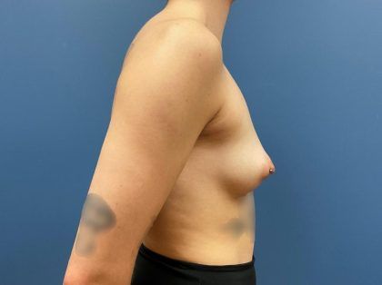 Breast Augmentation Before & After